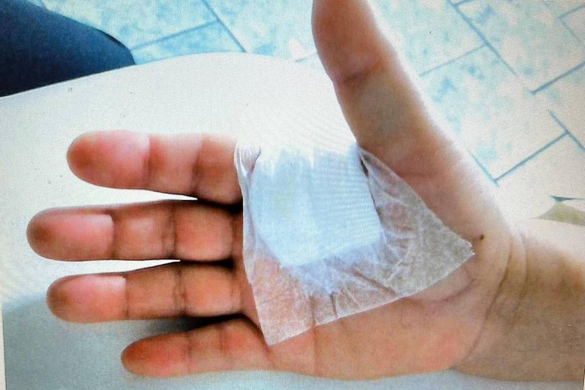 Imagem mostra a mão de um paciente com um curativo pós-cirúrgico