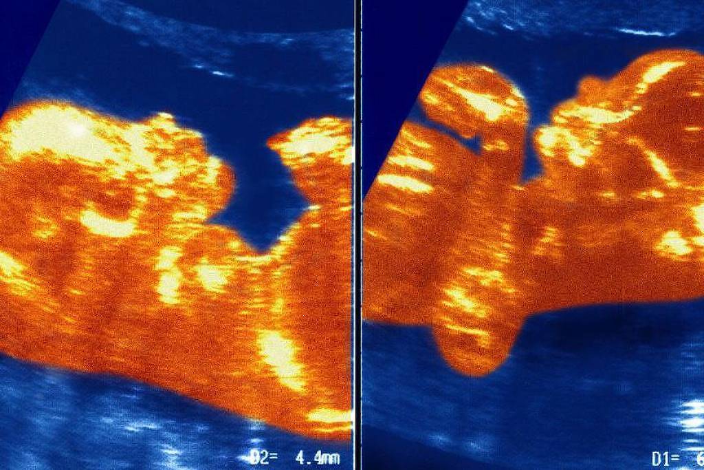 A imagem mostra duas imagens de ultrassom de um feto em desenvolvimento. A imagem à esquerda apresenta o feto em uma posição lateral, com detalhes visíveis da cabeça e do corpo. A imagem à direita mostra o feto em uma posição semelhante, mas com um ângulo diferente, permitindo ver mais claramente os contornos do corpo. Ambas as imagens têm um fundo azul e um tom laranja predominante, típico de ultrassons.