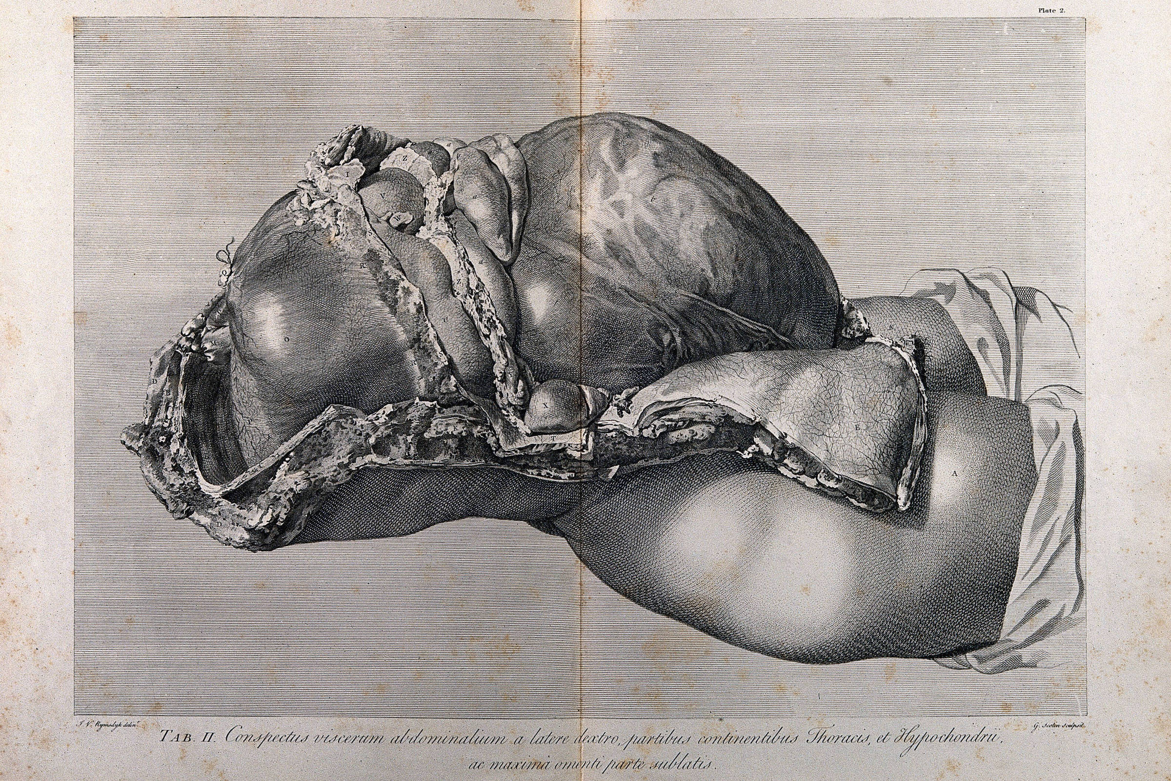 Ilustração em preto e branco mostra útero aumentado e deformado com tecido espesso e irregular, exposto sobre superfície plana. Braço humano parcialmente visível à direita, com tecido branco ao redor.