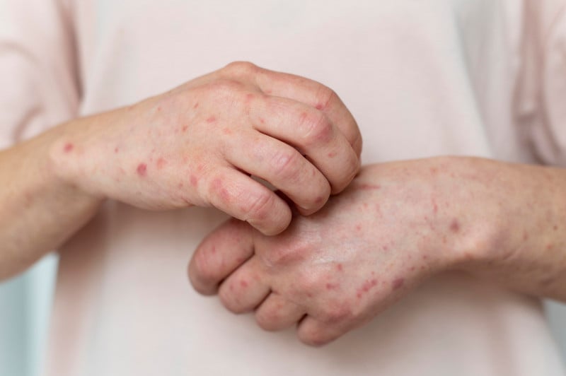 Anvisa amplia uso de remédios para lúpus e esclerose múltipla em crianças