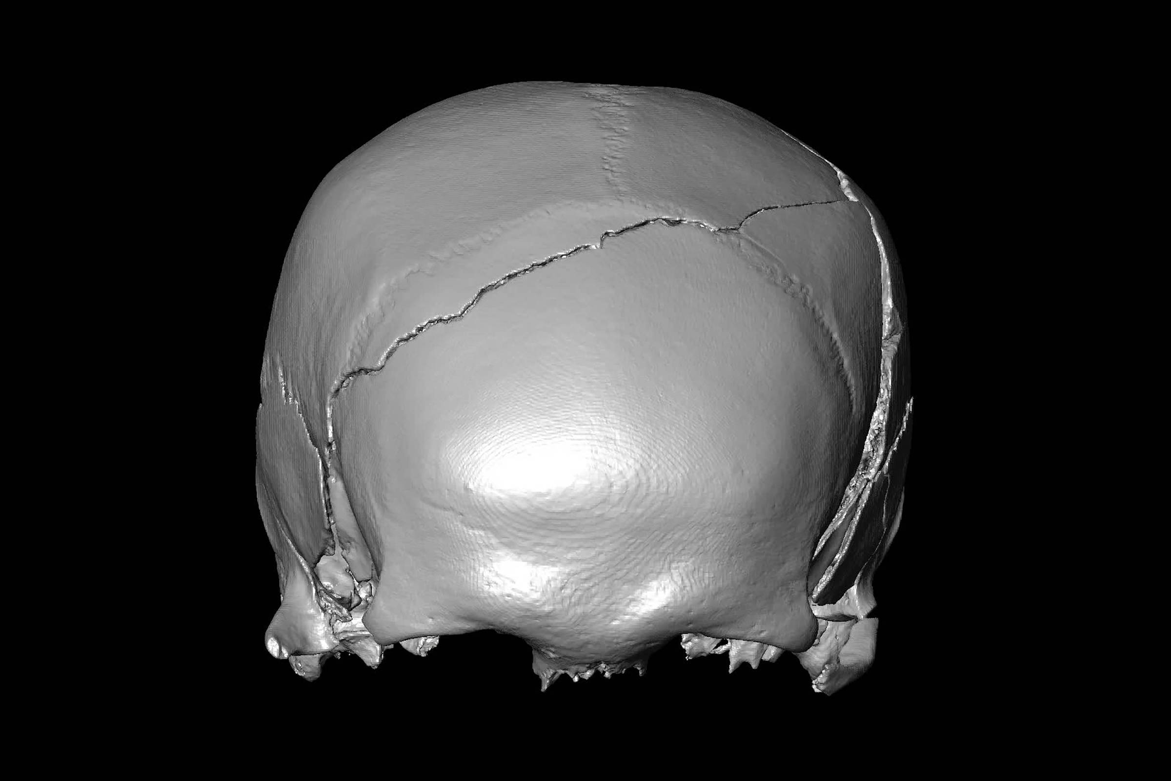 Imagem digital em tons de cinza mostra a parte superior de um crânio humano com fratura irregular na região frontal. O fundo é preto, destacando a superfície lisa e as fissuras do osso.